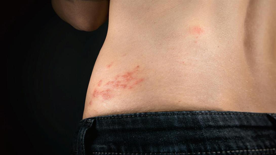 έρπης ζωστήρος