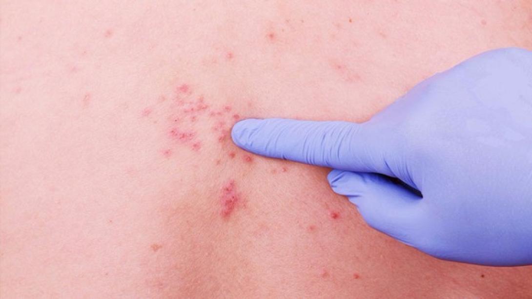 ερπης ζωστηρας