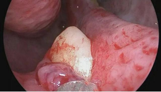 ΔΟΝΤΙ ΣΤΟ ΡΟΥΘΟΥΝΙ