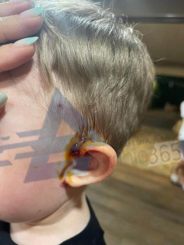 επίθεση αδέσποτου σκύλου σε παιδάκι