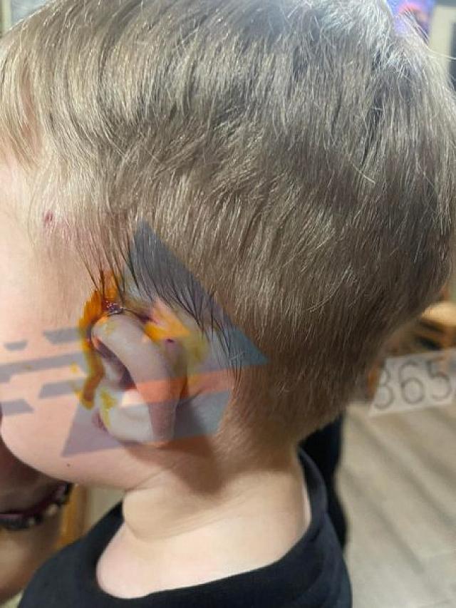 επίθεση αδέσποτου σκύλου σε παιδάκι