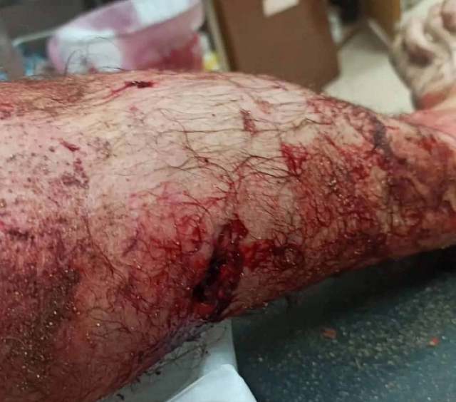 ροτβάιλερ δάγκωμα