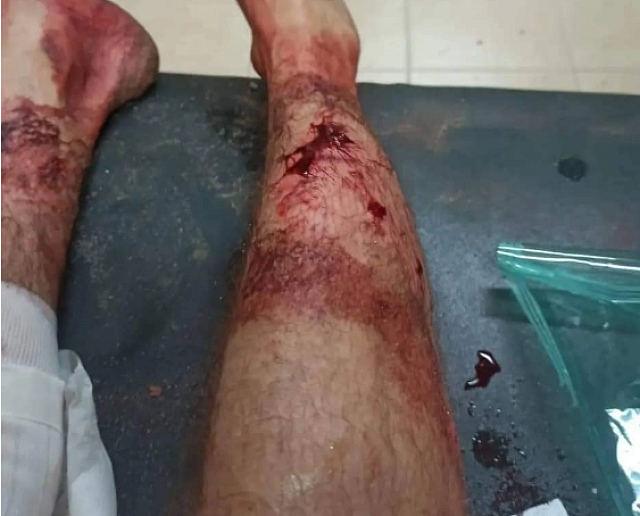 ροτβάιλερ δάγκωμα