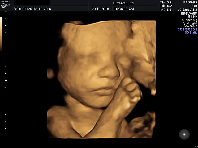 υπερηχογράφημα εμβρύου