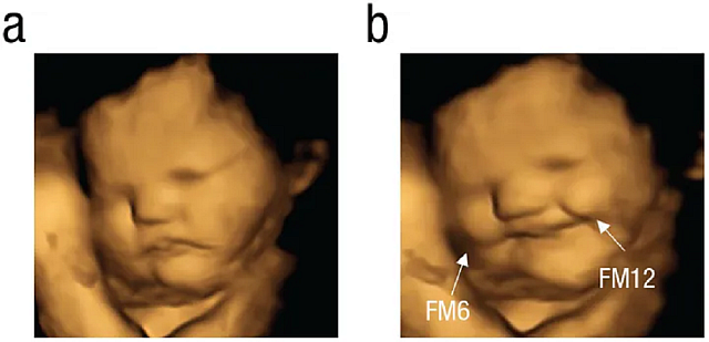 υπερηχογράφημα εμβρύου