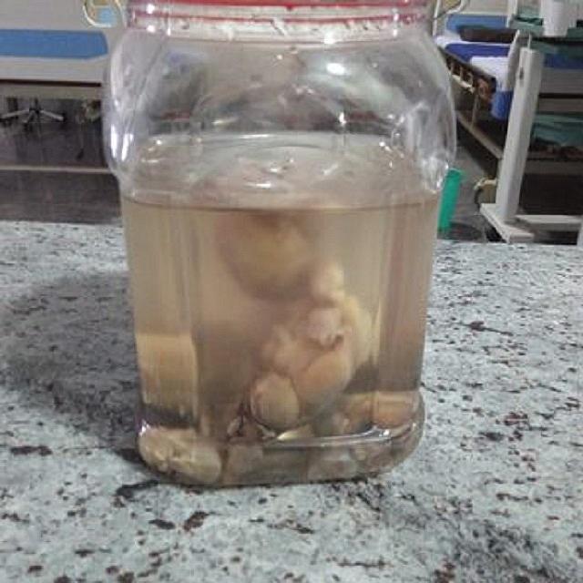 8 έμβρυα στο στομάχι βρεφους