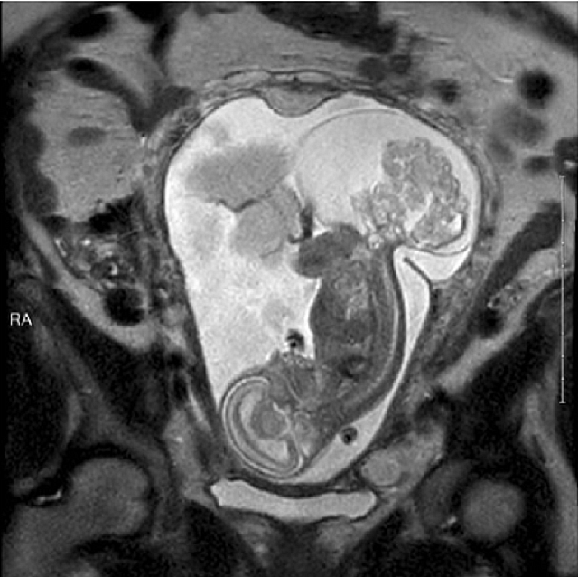  ιεροκοκκυγικό τεράτωμα 