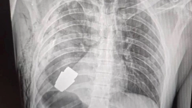  ακτινογραφία