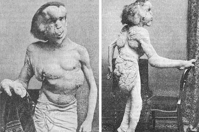 Ο Τζόζεφ Μέρικ, "ο άνθρωπος Ελέφαντας"