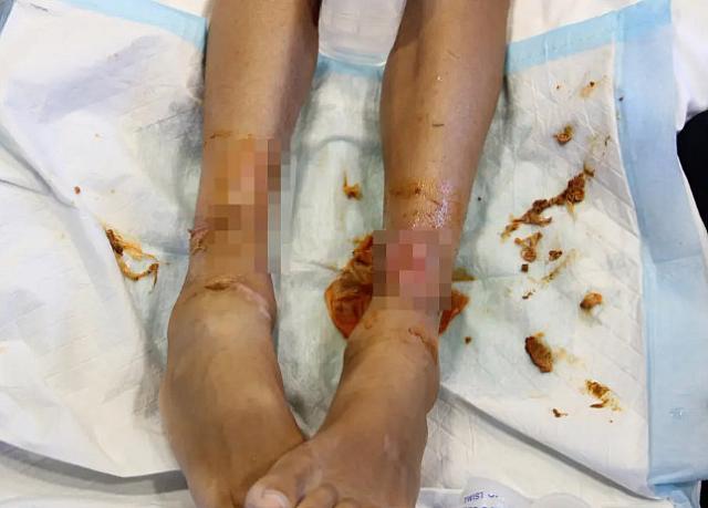 πληγες σε πόδια παιδιού