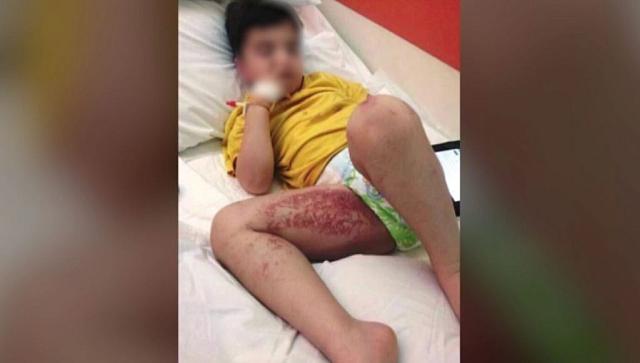 θαλάσσιες ανεμώνες τσίμπημα