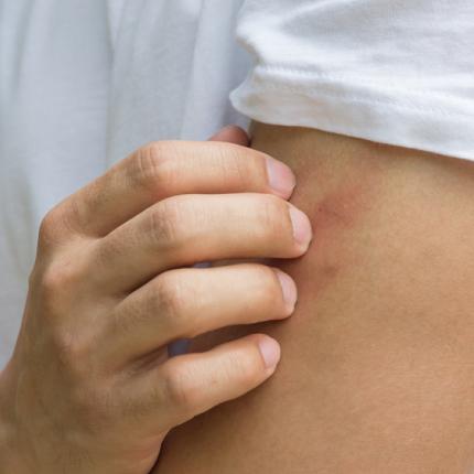 Ευλογιά των Πιθήκων