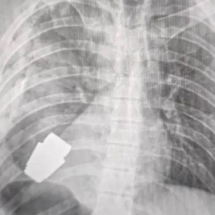  ακτινογραφία