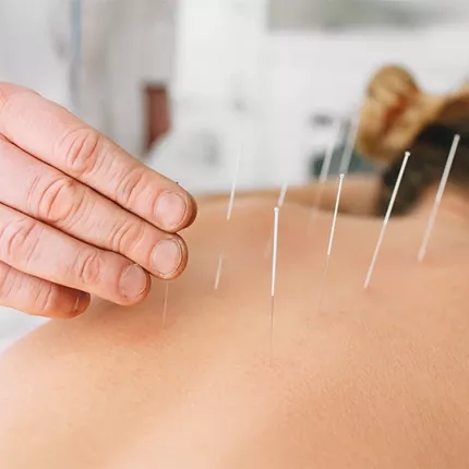 βελονισμος