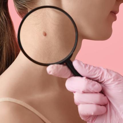 καρκινος δερματος