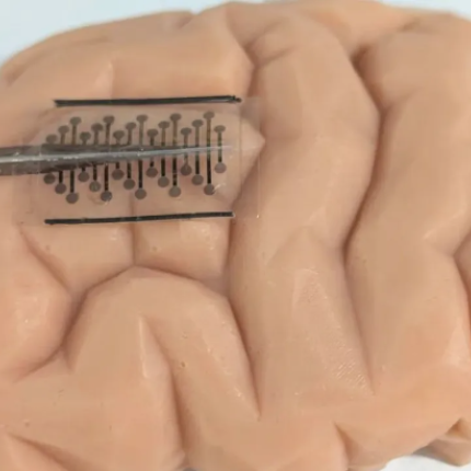 εμφύτευμα επιληψία