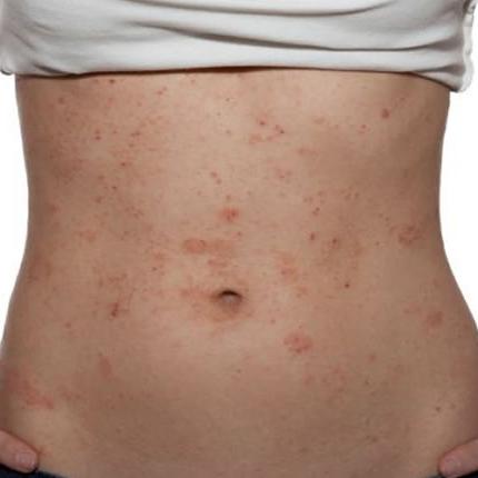 δερματίτιδα