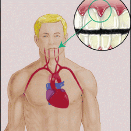 Η περιδοντίτιδα και η ουλίτιδα, "σήμα" για καρδιοπάθεια