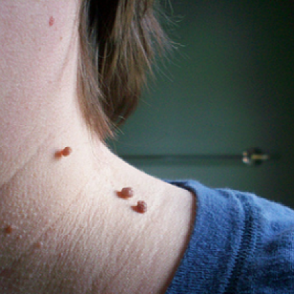 ελιές - δέρμα