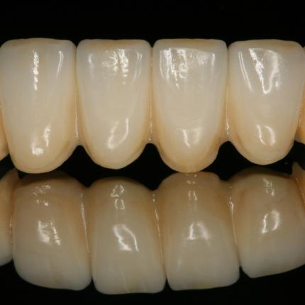 οδοντιατρική γέφυρα