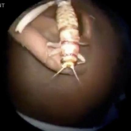 Γρύλος 7.5 εκατοστών ... τρύπωσε στο αυτί άνδρα (βίντεο)