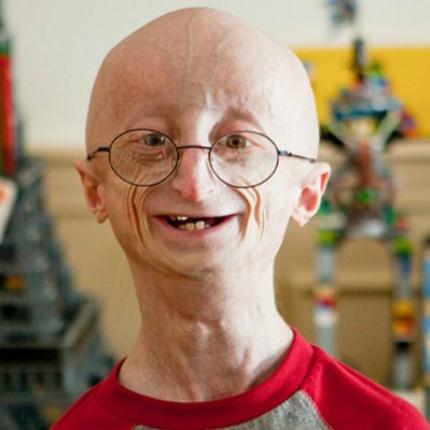 "Έφυγε " ο 17χρονος που έπασχε από πρόωρη γήρανση