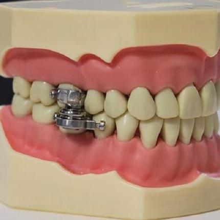 Συσκευή αδυνατίσματος που…κλειδώνει το στόμα του χρήστη