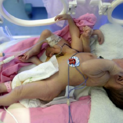 Κίνα: Γεννήθηκε με τέσσερα πόδια και τέσσερα χέρια 