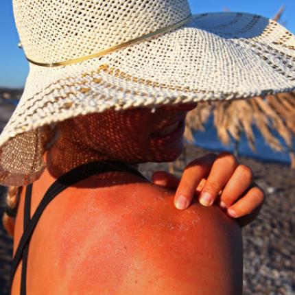 ηλιοθεραπεία εγκαύματα