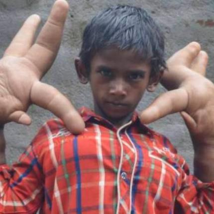 Ινδία: Το αγοράκι με τα μεγαλύτερα χέρια στον κόσμο (φωτογραφίες)