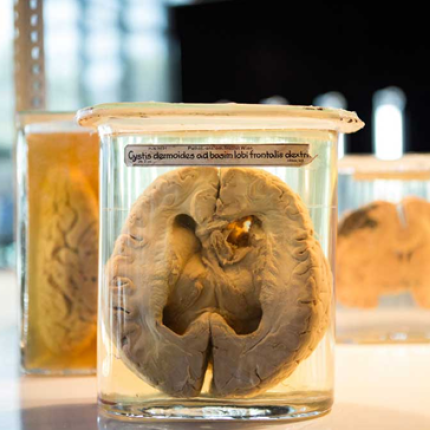 Υπερθυμησία: Η ασθένεια της υπερ-μνήμης.