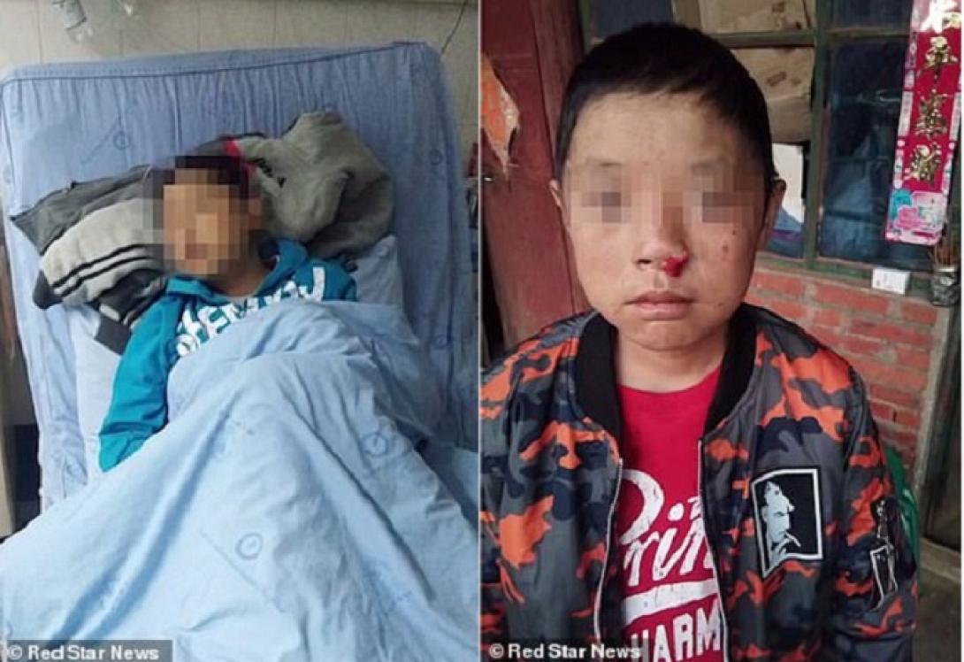 12χρονος έγινε «Δράκουλας»: Δεν μπορεί να δει ήλιο και αιμορραγεί από τα μάτια.jpg