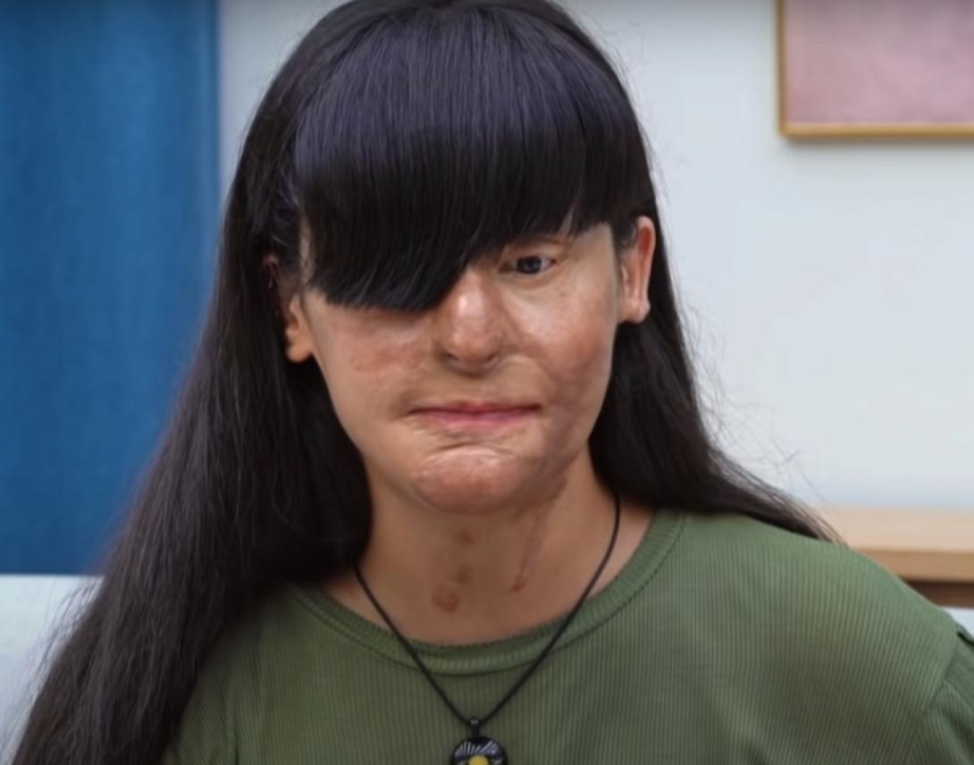 μπερφιν επιθεση με οξυ