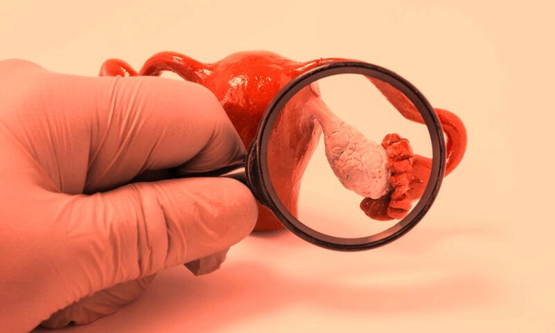 Επιστήμη: Αναμένεται νέο “επαναστατικό” τεστ που θα ανιχνεύει πολλούς  γυναικολογικούς καρκίνους