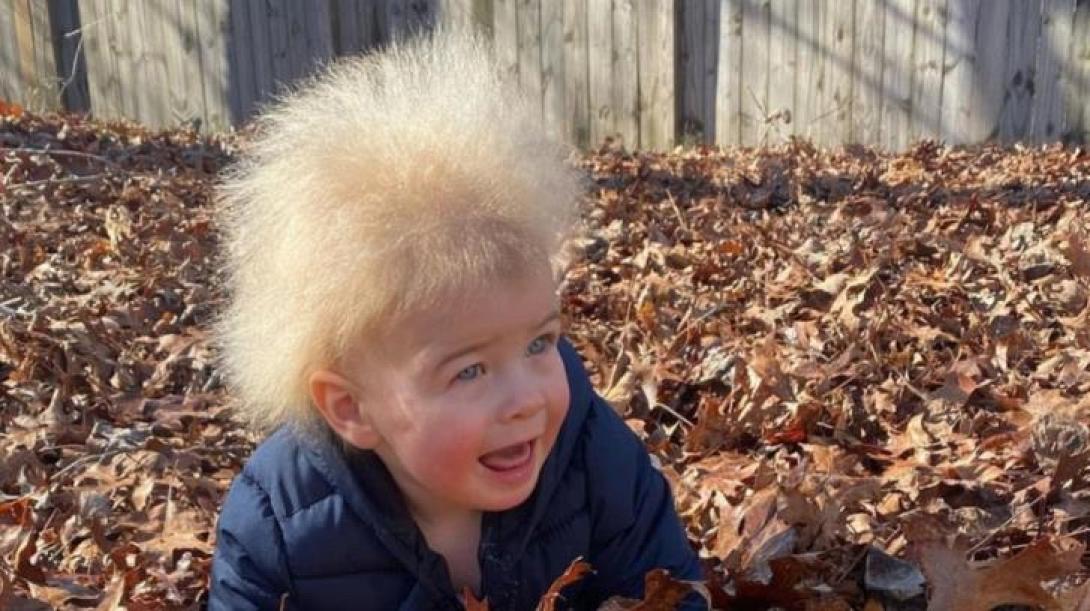 παιδι με συνδρομο αχτενιστων μαλλιων