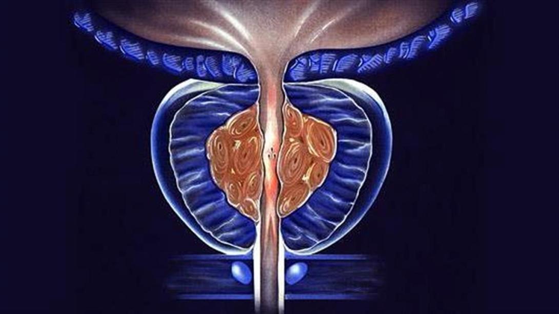 ΚΑΡΚΙΝΟΣ ΠΡΟΣΤΑΤΗ