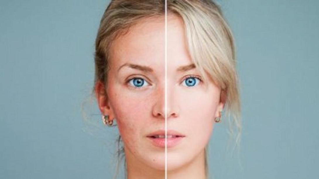 Το εξάνθημα στο πρόσωπο που προδίδει ένα ρευματικό νόσημα 