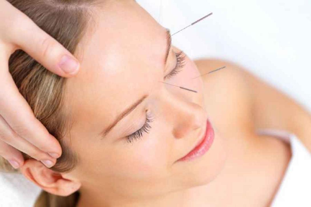 βελονισμός