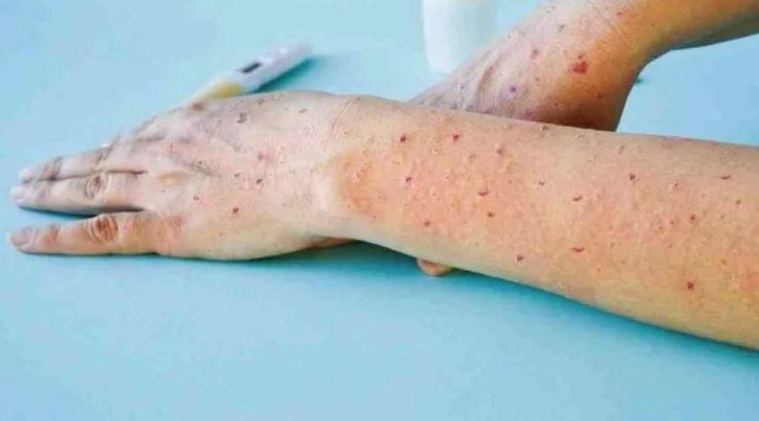 Γρίπη της ντομάτας