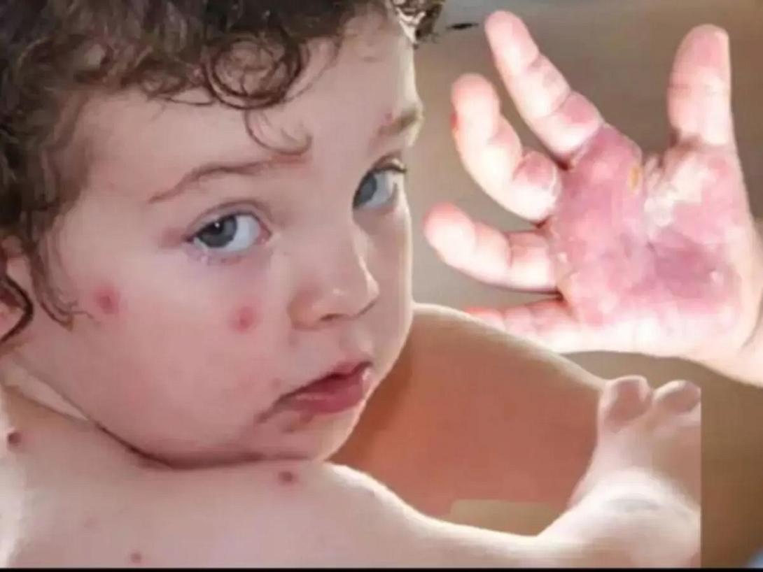 γρίπη της ντομάτας