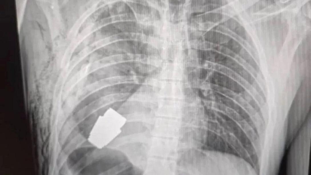  ακτινογραφία