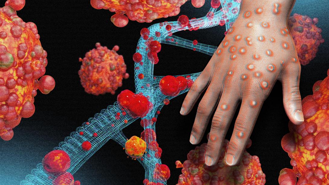 κρούσμα ευλογιάς των πιθήκων 