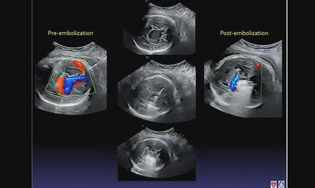 εγχείρηση αγέννητου μωρου