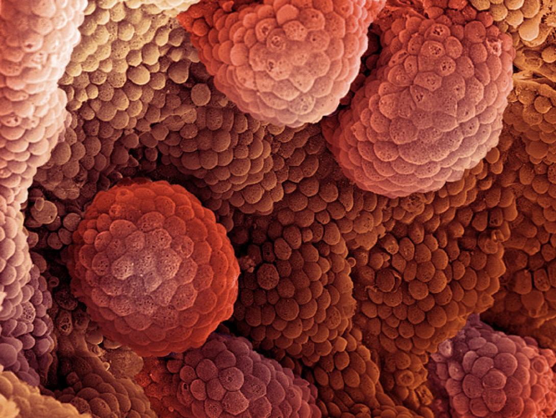 καρκινικοί όγκοι