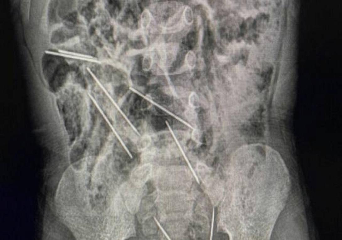 ακτινογραφία 