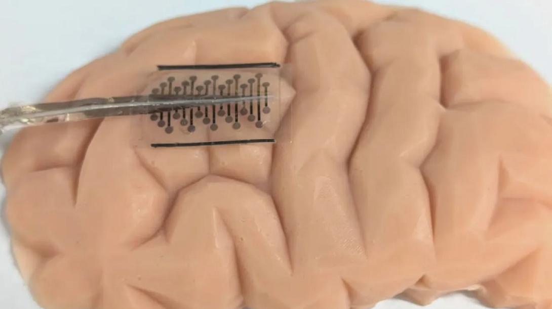 εμφύτευμα επιληψία