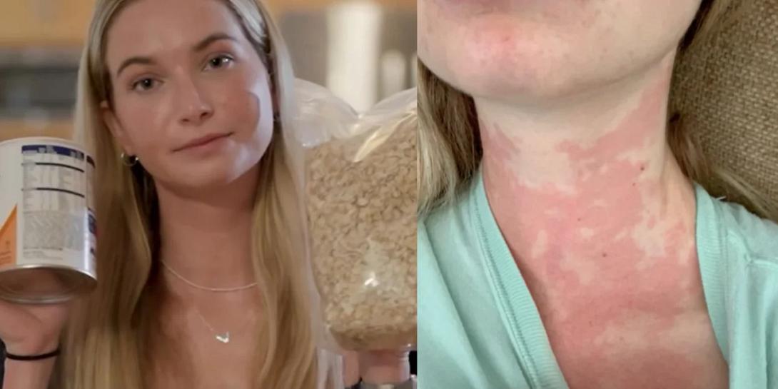 αλλεργία 25χρονη