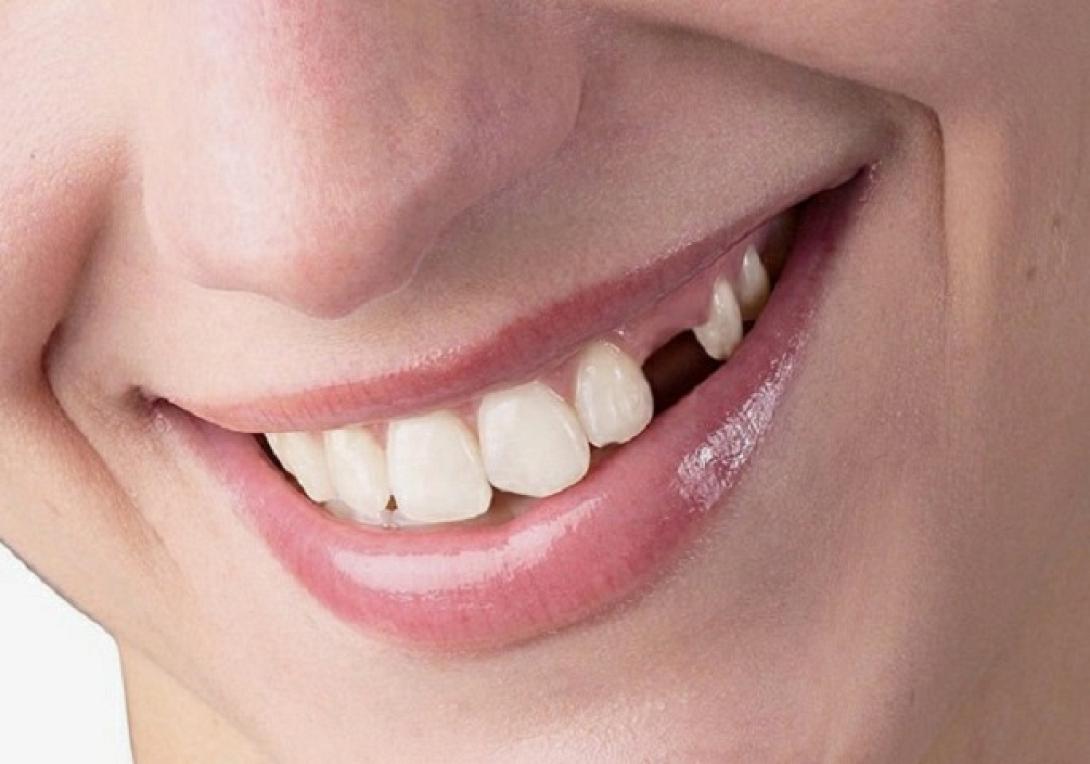 απωλεια δοντιων