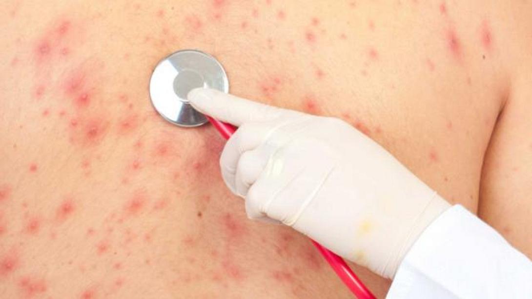 Τουλάχιστον 100 περιστατικά ιλαράς στις ΗΠΑ