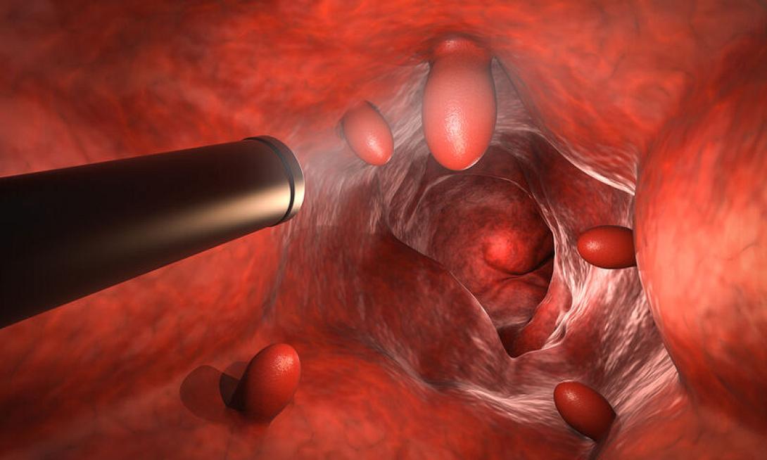 Υπάρχει τρόπος να γλυτώσουμε την κολονοσκόπηση.jpg